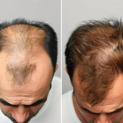 Proskire Hair Growth Serum – Reduces Hair Fall, Boosts Hair Density, Activates Follicles – For Bald Patches, Receding Hairline & Thinning Hair